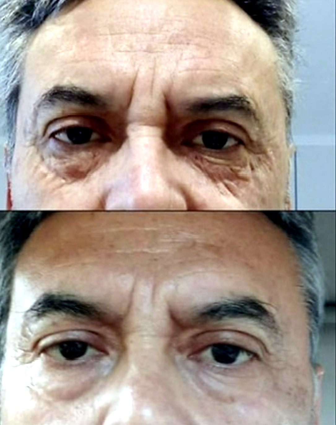 Antes y después · Peeling Periocular PG Skincare